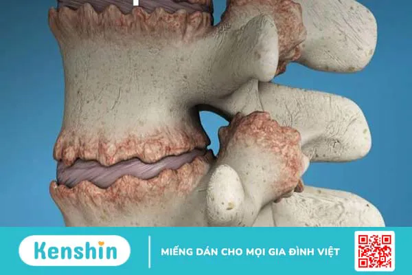 Cảnh báo 7 triệu chứng thoái hóa khớp điển hình không thể chủ quan