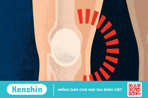 Cảnh báo 7 triệu chứng thoái hóa khớp điển hình không thể chủ quan