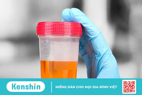 Cảnh báo 8 dấu hiệu sỏi thận có thể bạn chưa biết