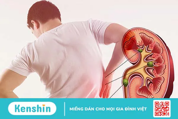 Cảnh báo 8 dấu hiệu sỏi thận có thể bạn chưa biết