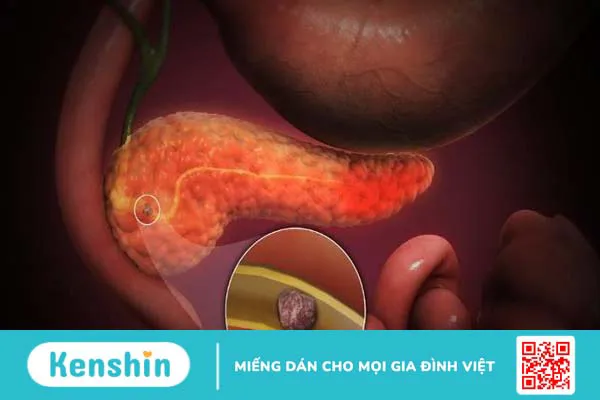 Cảnh báo 8 triệu chứng viêm tụy cấp bạn không thể bỏ qua