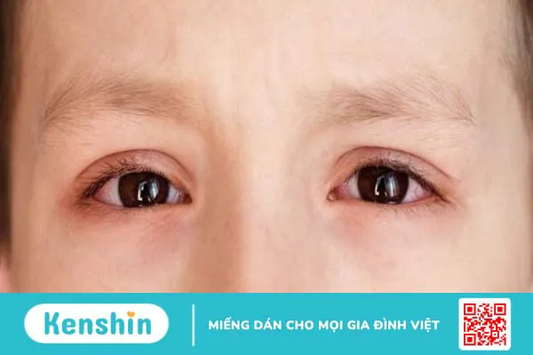 Cảnh báo nguy hiểm khi nhỏ sữa mẹ trực tiếp vào mắt của trẻ sơ sinh