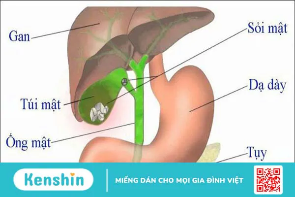 Cảnh báo nguyên nhân sỏi mật phổ biến hàng đầu bạn nên biết