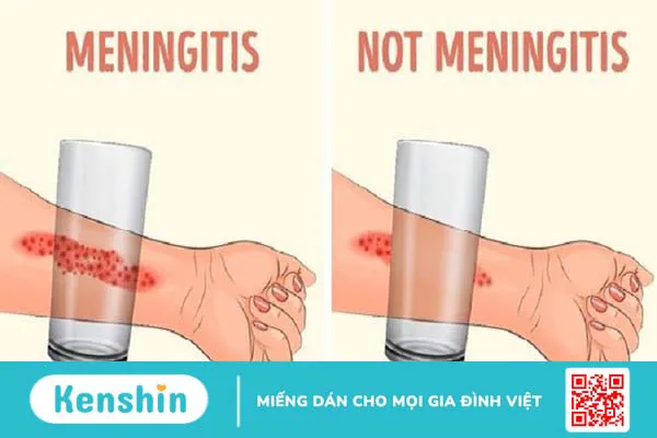 Cảnh báo: Những dấu hiệu của bệnh viêm màng não bố mẹ cần biết để bảo vệ trẻ