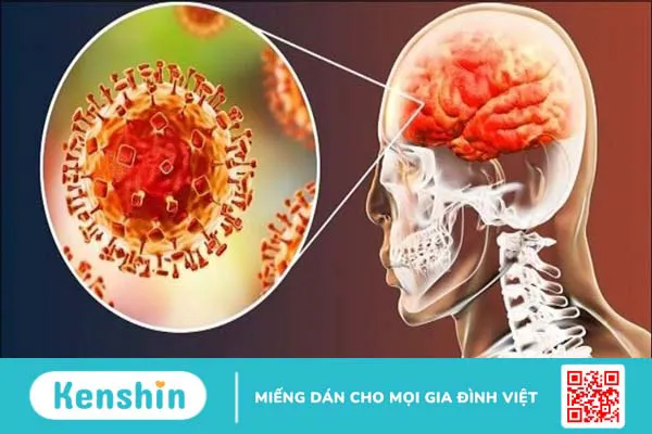 Cảnh báo về virus Nipah: có thể gây ra đại dịch toàn cầu