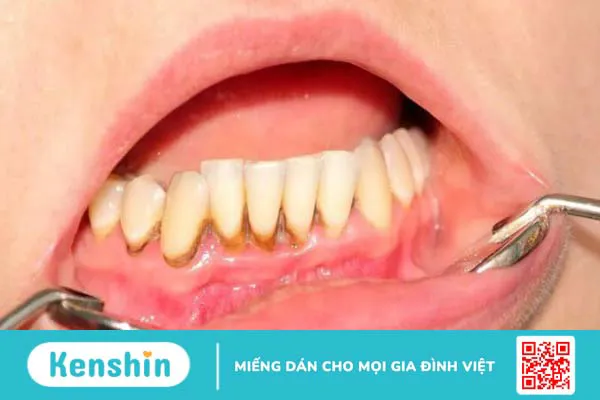 Cao răng là gì? Ảnh hưởng của cao răng và tại sao phải lấy cao răng?