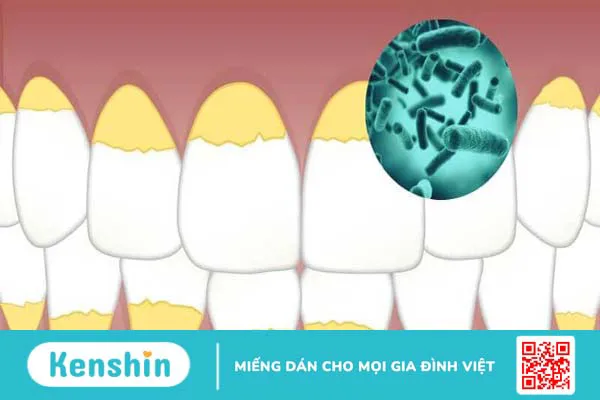 Cao răng là gì? Ảnh hưởng của cao răng và tại sao phải lấy cao răng?