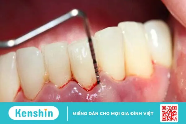 Cao răng là gì? Ảnh hưởng của cao răng và tại sao phải lấy cao răng?