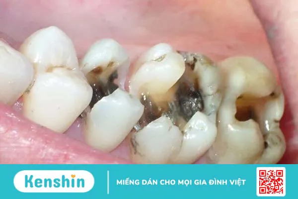 Cao răng là gì? Ảnh hưởng của cao răng và tại sao phải lấy cao răng?