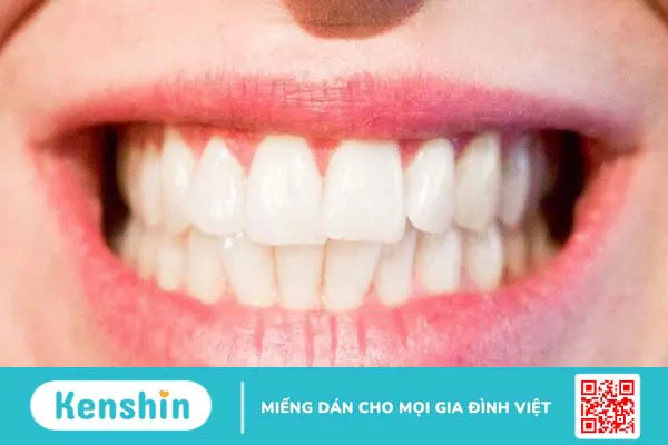 Cao răng là gì? Ảnh hưởng của cao răng và tại sao phải lấy cao răng?