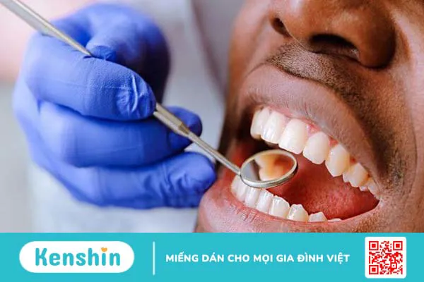 Cao răng là gì? Ảnh hưởng của cao răng và tại sao phải lấy cao răng?