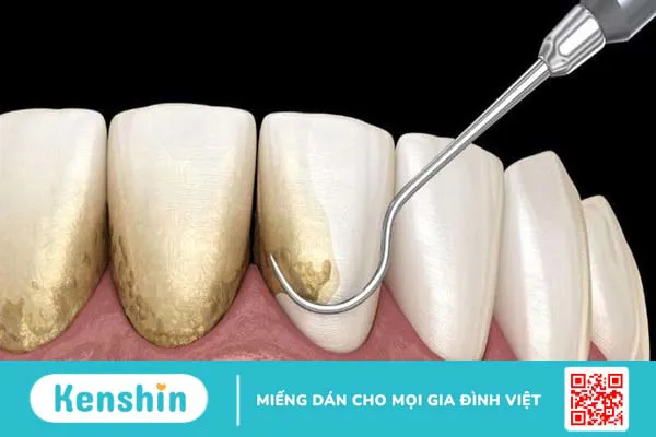 Cao răng là gì? Ảnh hưởng của cao răng và tại sao phải lấy cao răng?