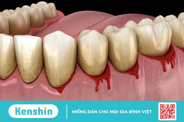 Cao răng là gì? Ảnh hưởng của cao răng và tại sao phải lấy cao răng?