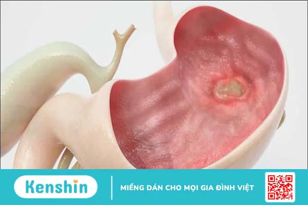 Cắt dạ dày có thể gặp biến chứng gì? Chăm sóc bệnh nhân sau cắt dạ dày