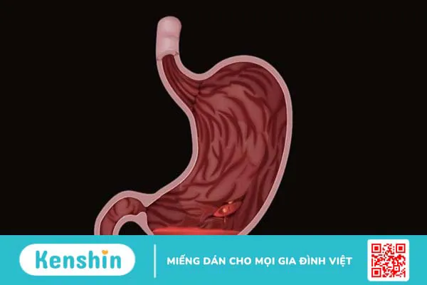 Cắt dạ dày có thể gặp biến chứng gì? Chăm sóc bệnh nhân sau cắt dạ dày