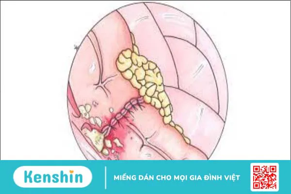 Cắt dạ dày có thể gặp biến chứng gì? Chăm sóc bệnh nhân sau cắt dạ dày