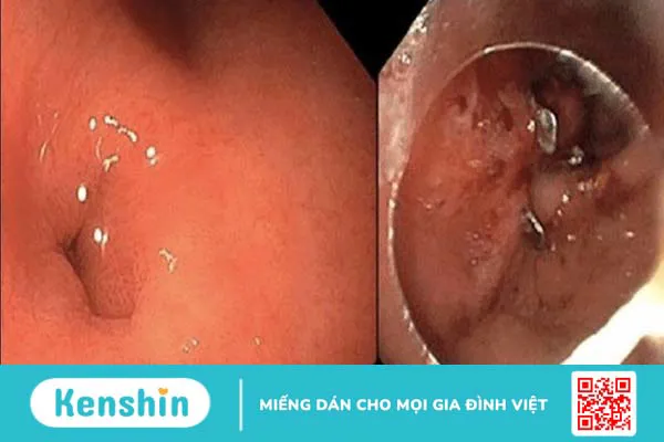 Cắt dạ dày có thể gặp biến chứng gì? Chăm sóc bệnh nhân sau cắt dạ dày