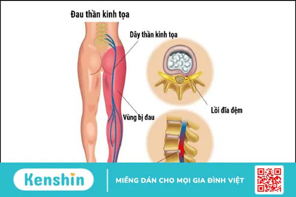 Cây kê huyết đằng có tác dụng gì? 12 vị thuốc kê huyết đằng hiệu quả