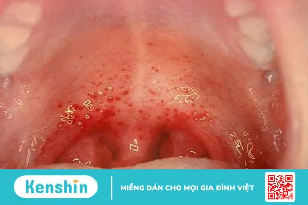 Cây vòi voi có tác dụng gì? Chữa được bệnh gì? Lưu ý khi sử dụng