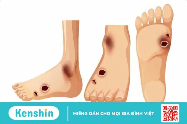 Chăm sóc bệnh nhân tiểu đường trong mùa dịch Covid-19 tại nhà