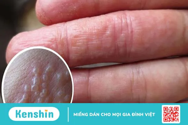 Chàm và viêm da cơ địa có giống nhau không? Cách phòng ngừa hiệu quả