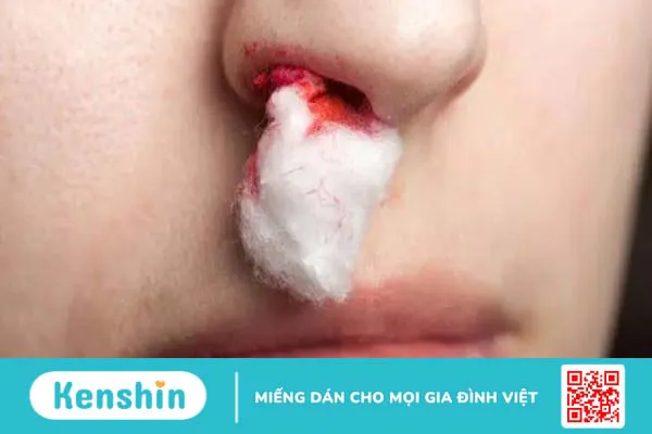 Chảy máu cam có nguy hiểm không? Cách xử lý và phòng ngừa hiệu quả