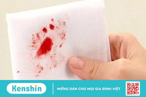 Chảy máu cam có nguy hiểm không? Cách xử lý và phòng ngừa hiệu quả