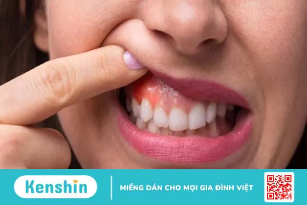 Chảy máu chân răng là bệnh gì? 7 nguyên nhân gây chảy máu chân răng