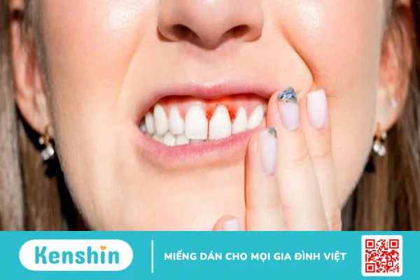 Chảy máu chân răng là bệnh gì? 7 nguyên nhân gây chảy máu chân răng