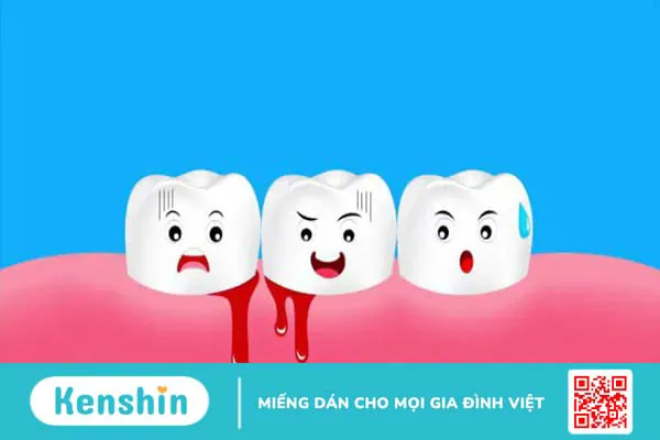 Chảy máu chân răng là bệnh gì? 7 nguyên nhân gây chảy máu chân răng