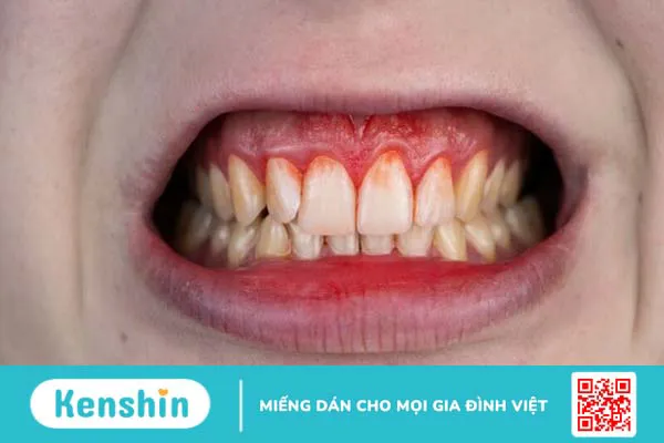 Chảy máu chân răng là bệnh gì? 7 nguyên nhân gây chảy máu chân răng