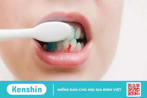 Chảy máu chân răng là bệnh gì? 7 nguyên nhân gây chảy máu chân răng