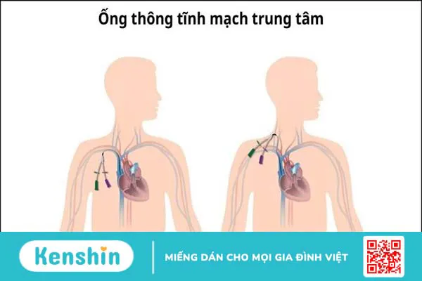 Chạy thận nhân tạo là gì? Quy trình, lợi ích và cách chăm sóc hiệu quả