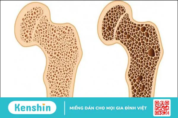 Chạy thận nhân tạo là gì? Quy trình, lợi ích và cách chăm sóc hiệu quả