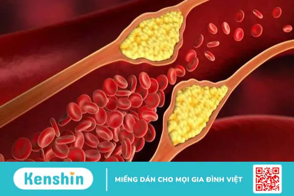 Chỉ số LDL-C trong máu là gì? LDL bình thường là bao nhiêu?