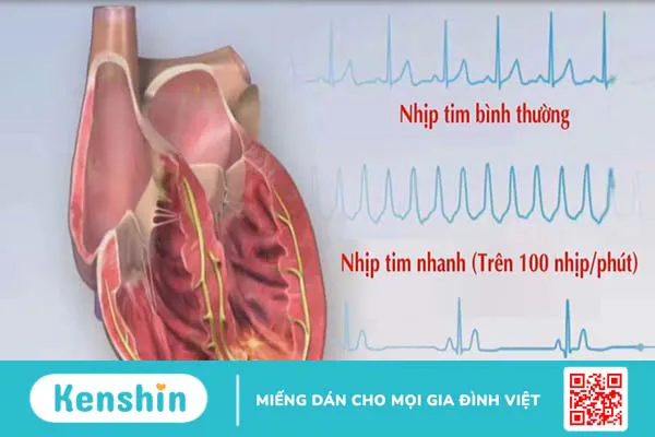 Chứng mệt tim ở nữ sinh tuổi dậy thì