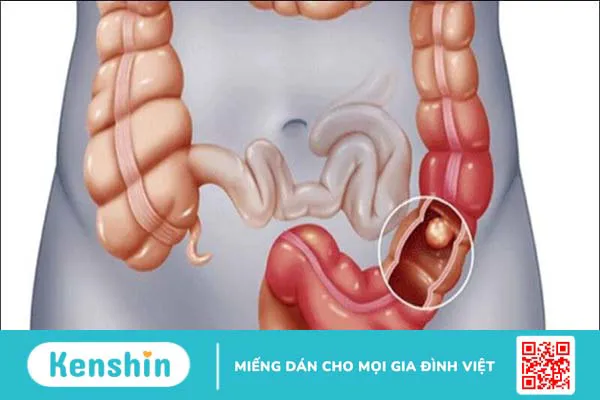 Cỏ lúa mạch là gì? Lợi ích sức khỏe và lưu ý khi sử dụng