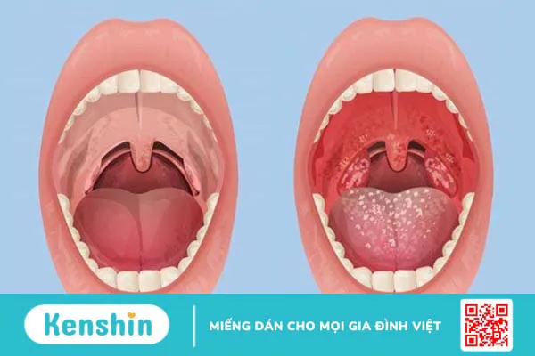 Cỏ mực có tác dụng gì? 12 tác dụng của cây cỏ mực (cỏ nhọ nồi)