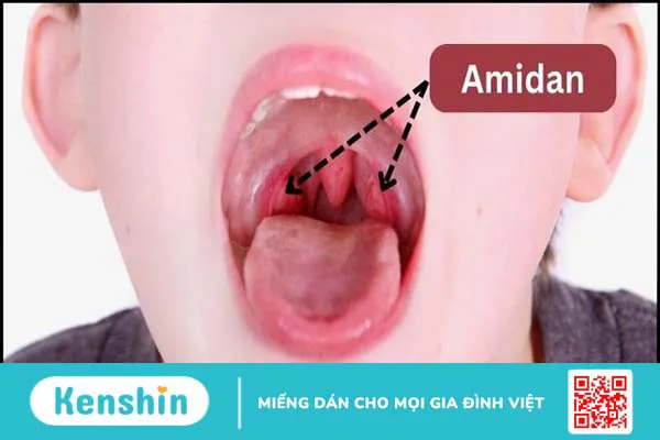 Có nên cắt amidan không? Khi nào nên cắt amidan?