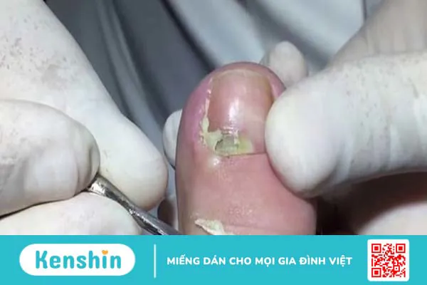 Có nên lấy khoé móng chân không? Cách lấy và chăm sóc sau khi lấy khoé