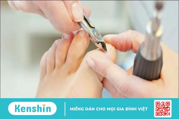 Có nên lấy khoé móng chân không? Cách lấy và chăm sóc sau khi lấy khoé