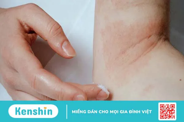 Có nên sử dụng giấm táo điều trị eczema không?