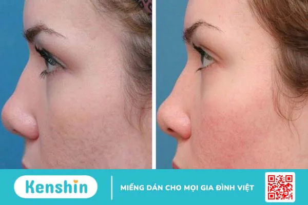 Có nên sử dụng giấm tạo trị sẹo mụn không?