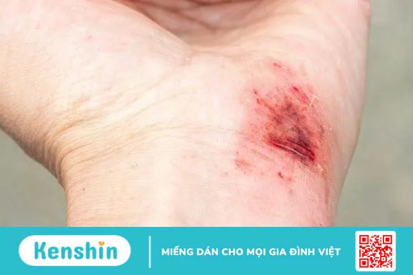 Có nên sử dụng mật ong manuka trị mụn không?