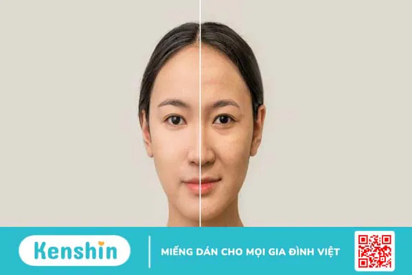 Có nên sử dụng mật ong manuka trị mụn không?