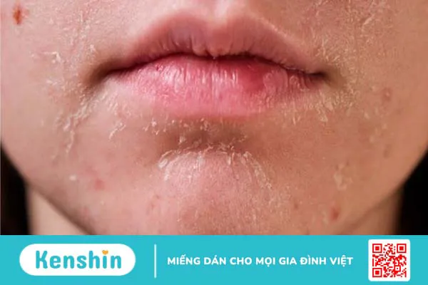 Có nên sử dụng mật ong manuka trị mụn không?