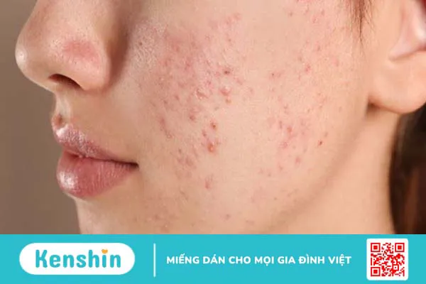 Có nên sử dụng mật ong manuka trị mụn không?