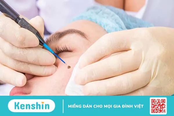 Có nên tẩy nốt ruồi tại nhà? Lưu ý và cách tẩy nốt ruồi an toàn