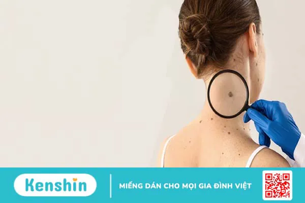 Có nên tẩy nốt ruồi tại nhà? Lưu ý và cách tẩy nốt ruồi an toàn