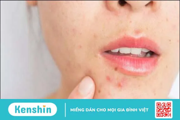 Có nên tẩy tế bào chết cho da mụn không và các lưu ý khi thực hiện